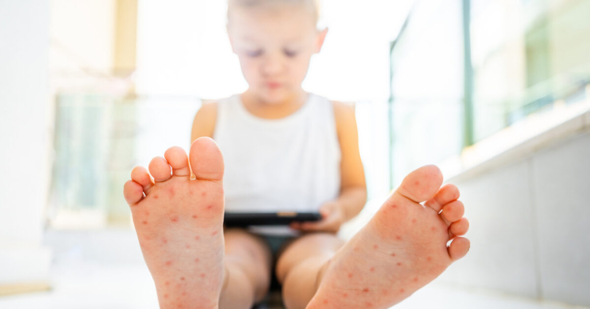 Σε έξαρση ο ιός Κοξάκι στα παιδιά: Οι 3 περιοχές με τα περισσότερα κρούσματα και το ανησυχητικό «κοκτέιλ» με τη γρίπη